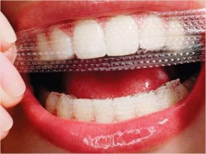 Teeth-Whitening Strips