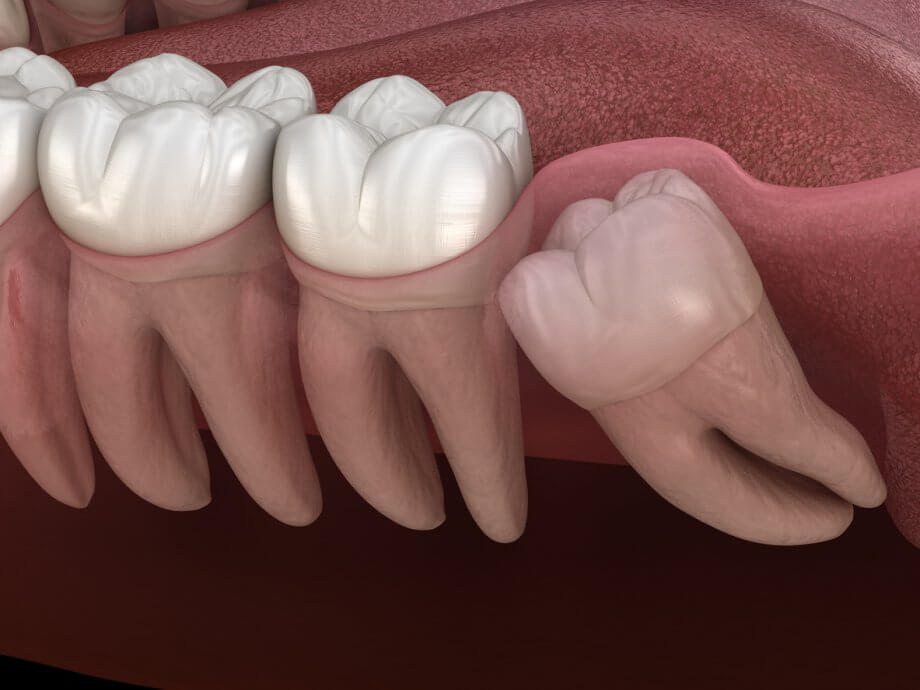 Impacted tooth