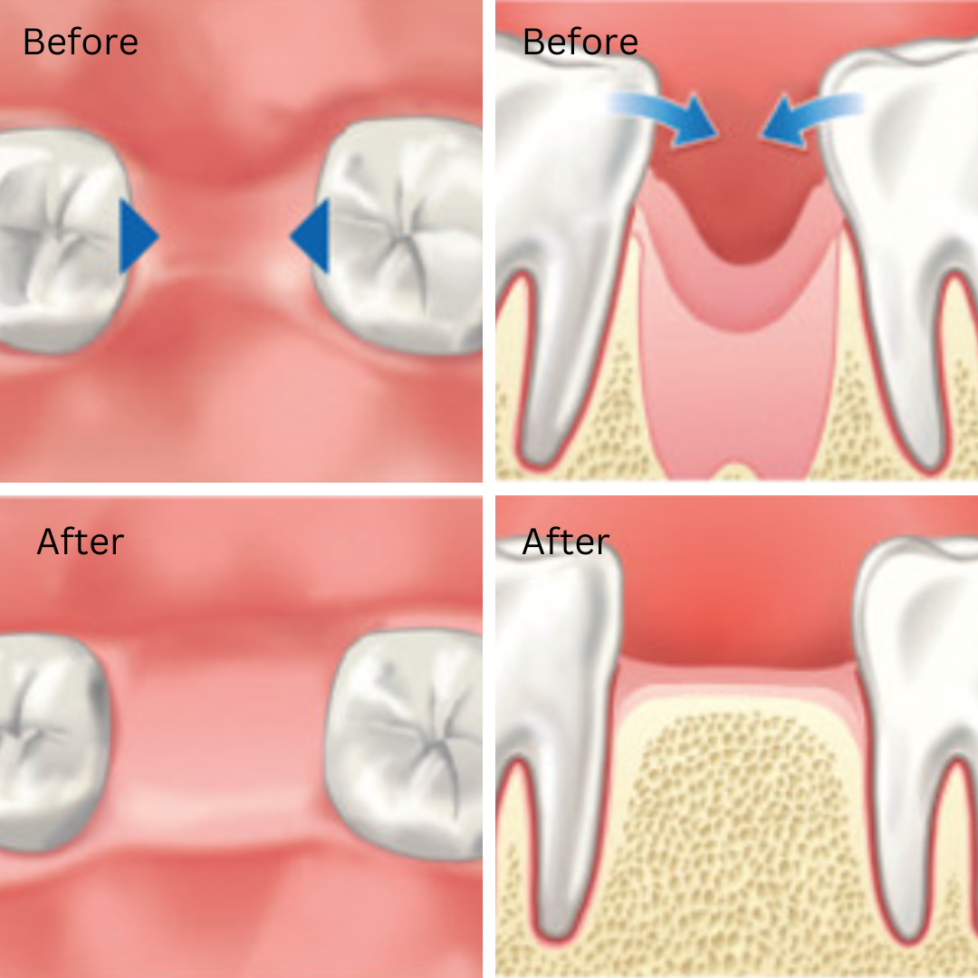 bone grafting before and after